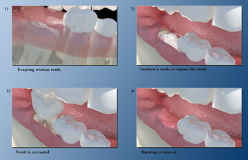 Wisdom Tooth Removal